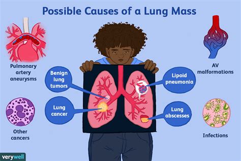 Possible Causes and Diagnosis of a Lung Mass .